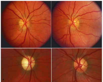 Ischemic Optic Neuropathies